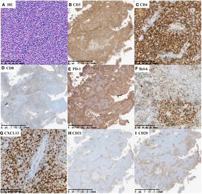 Clinicopathologic analysis of nodal T-follicular helper cell lymphomas, a multicenter retrospective study from China